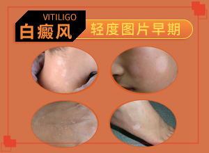 皮肤有白色斑点是怎么回事？起白斑是什么病-白斑病发的原因