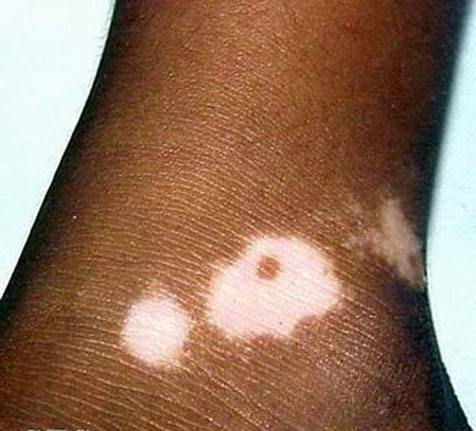 小孩出现白癜风是什么原因