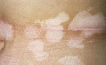 适合白癜风患者的运动项目有哪些 适合白癜风患者的运动项目有哪些