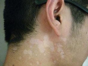 白癜风要吃什么比较好 白癜风要吃什么比较好