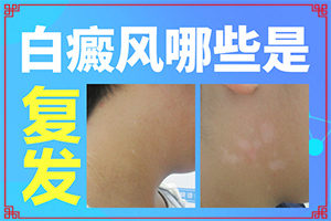 白癞风能治疗好吗(怎样治疗好呢)-早期白癜的治疗