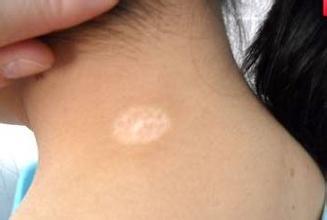 白癜风会给孕妇带来哪些危害