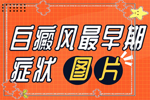 白殿病的治疗方法(如何调节控制)-白癜风怎么治疗可以好