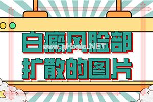 白班怎么治疗最有效[白癜风容易治疗吗]中年女性白班病怎么治疗