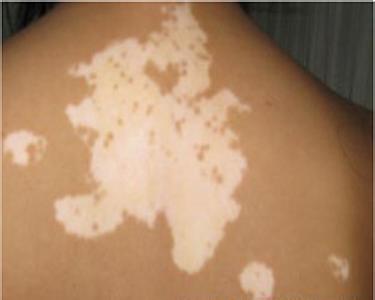 白癜风发病期如何护理 白癜风发病期如何护理