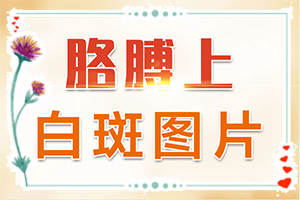 白点癫风早期治疗药物[日常诊治方法是]手上长白斑用什么药擦好
