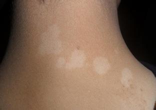 小孩得了白颠风的原因 小孩得了白颠风的原因