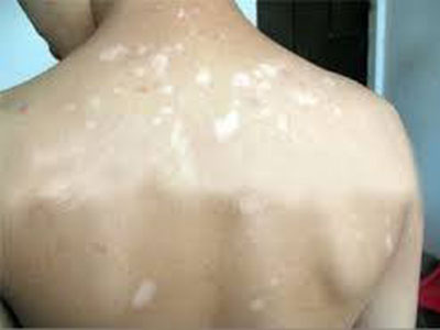 日常中青少年白癜风的病因和防治有哪些 日常中青少年白癜风的病因和防治有哪些