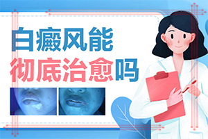 肢端白斑最好的治疗方法[需要注意什么]白癜风的中医治疗方法