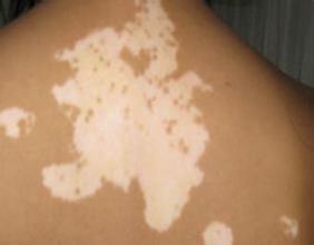 小孩早期白癜风症状是怎样的 小孩早期白癜风症状是怎样的