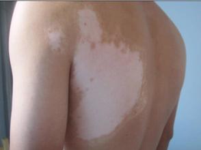 吃什么对白癜风好