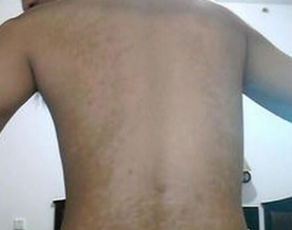 白癜风患者运动项目的选择以及运动中的运动事项