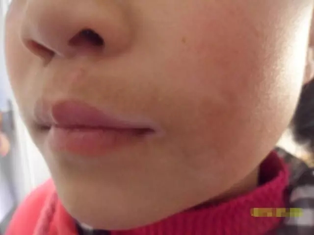 零食会诱发儿童出现白癜风吗