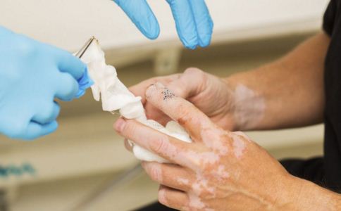 手部白癜风的注意事项有哪些呢 手部白癜风的注意事项有哪些呢