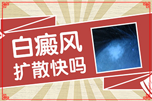 「资历深」起白斑是什么病?皮肤长白斑是怎么引起的