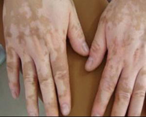 老年白癜风能吗