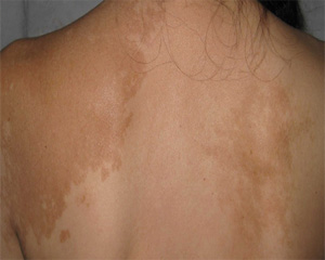 白癜风出现会遗传吗 白癜风出现会遗传吗