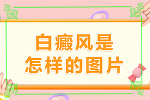 婴幼儿脸上有一块白斑怎么回事[有什么因素呢]长白班是怎么回事