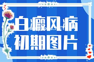 （白癞风）白巅峰能治愈吗-民间土方法