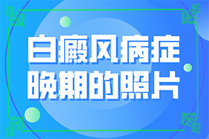 皮肤出现白斑点原因“身上的白斑怎么回事”诱发的原因有