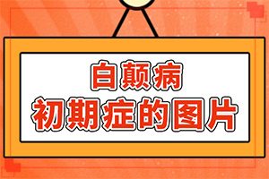 「前十名名次」长白斑是什么引起的「重点」白癜风应做什么检查
