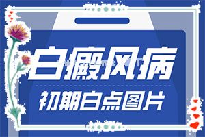 自癜风能治愈吗-节段型白癜风治疗方法有哪些