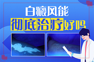 白癞风病是什么原因?什么原因能引起白斑-哪些诱因引起