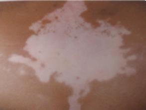 儿童面部白癜风该怎么办 儿童面部白癜风该怎么办