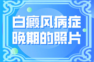 白班可以治好嘛[为什么会治不好]治疗白瘨风用什么办法