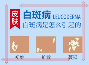 白癫疯能治好吗[诊疗白斑这些是关键]白殿风长在脸上好治吗