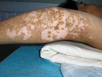 听给你介绍白癜风的典型症状 听给你介绍白癜风的典型症状