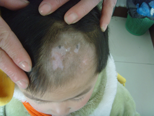 夏季白癜风患者要怎么进行护理 夏季白癜风患者要怎么进行护理