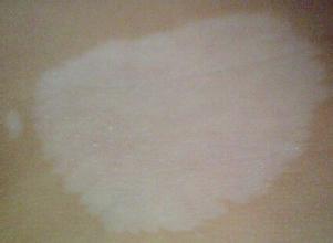 青少年白癜风都有哪些危害 青少年白癜风都有哪些危害