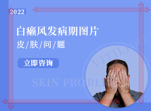 白癞风图片早期图片-白斑初期什么样-患上了有哪些症状