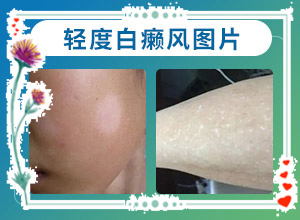 白斑是怎么引起的它有什么样的后果？哪些因素会导致白癜风