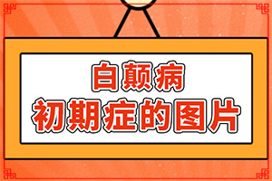 指端白癫风怎么治疗更好[怎么治疗比较好]白殿疯怎么医治最好