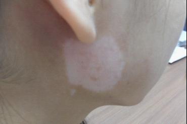 白癜风患者夏季4大禁忌