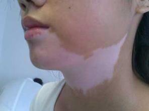 　黏膜性白癜风发病症状