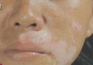 为什么白癜风治疗这么困难 为什么白癜风治疗这么困难