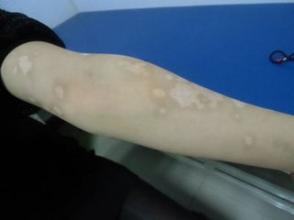 合肥华夏白癜风院附属中医医院电话 合肥华夏白癜风院附属中医医院电话