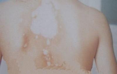 有哪些日常小偏方可以治疗白癜风 有哪些日常小偏方可以治疗白癜风