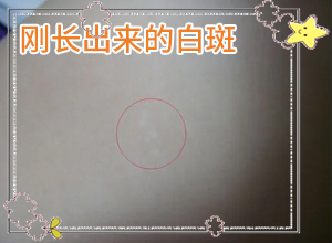 「收费排名」脸上长白斑点什么原因「诚信医疗」色素减退白斑是怎么造成的