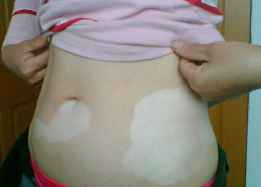 治疗白癜风该注意什么事