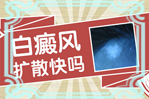 白癫风能吗-色素减退性白斑怎么-更快的治疗好白癜风