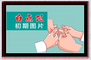 初期白癜风不治疗有多大几率可以