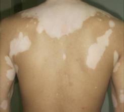 身上为什么会长白癜风 身上为什么会长白癜风