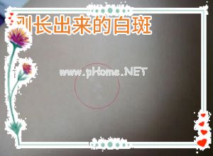 解决方案-白斑到底能不能根治会不会复发-遗传白癞风能治好吗