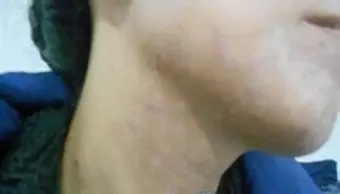 白斑的早期症状图片