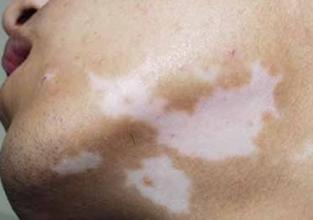 有哪些皮肤病与白癜风的症状相似