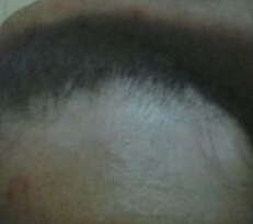 白癜风患者如何进行个人护理 白癜风患者如何进行个人护理